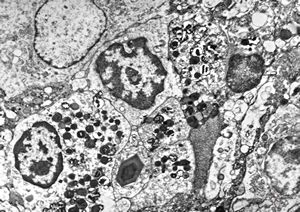 F,1y. | eosinophilic granuloma - Charcot- Leyden crystals F,1y. | eosinophilic granuloma - Charcot- Leyden crystals